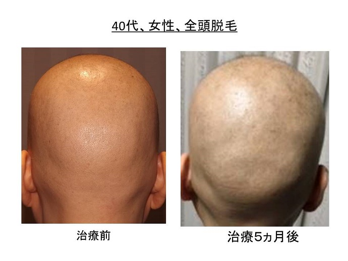 円形脱毛症　病院""